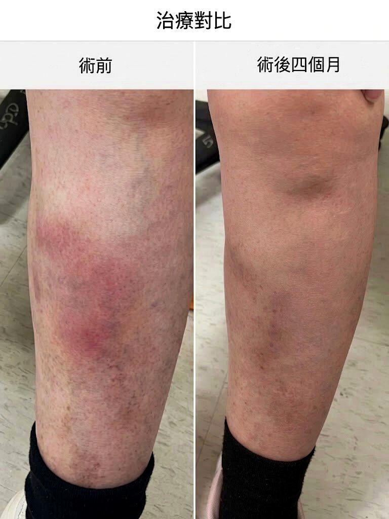 痛到无法走 7旬嬷长时间站着顾孙酿静脉曲张恶化 医示警：严重恐没命